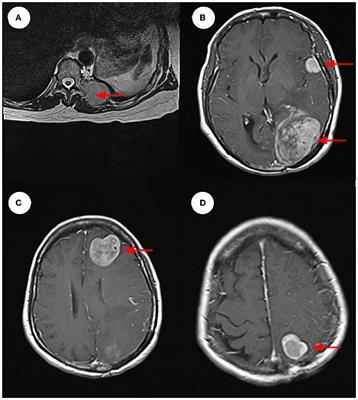 A rare case of intracranial solitary fibrous tumor that is still alive after multiple surgical resections: a case report and review of the literature